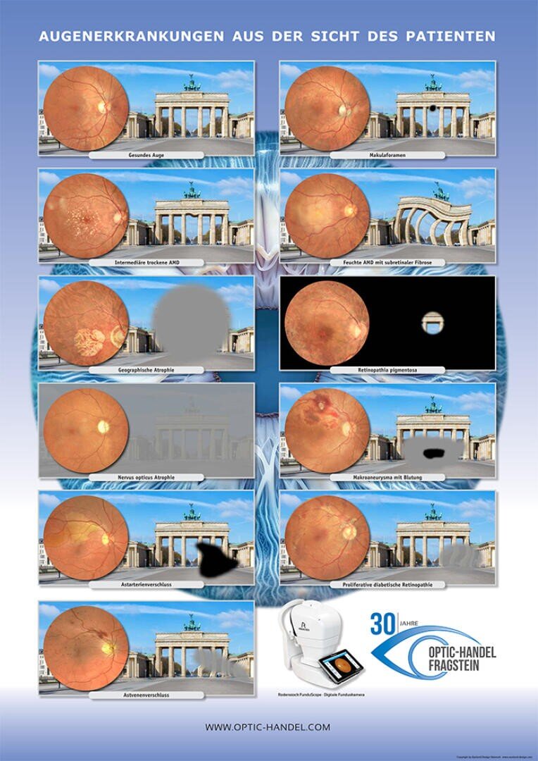 Eine deutschsprachige Tafel zeigt Bilder des Brandenburger Tors aus der Sicht von Patienten mit verschiedenen Augenerkrankungen sowie Netzhautfotos und veranschaulicht Symptome wie Unschärfe, dunkle Flecken, Tunnelblick und Trübung.