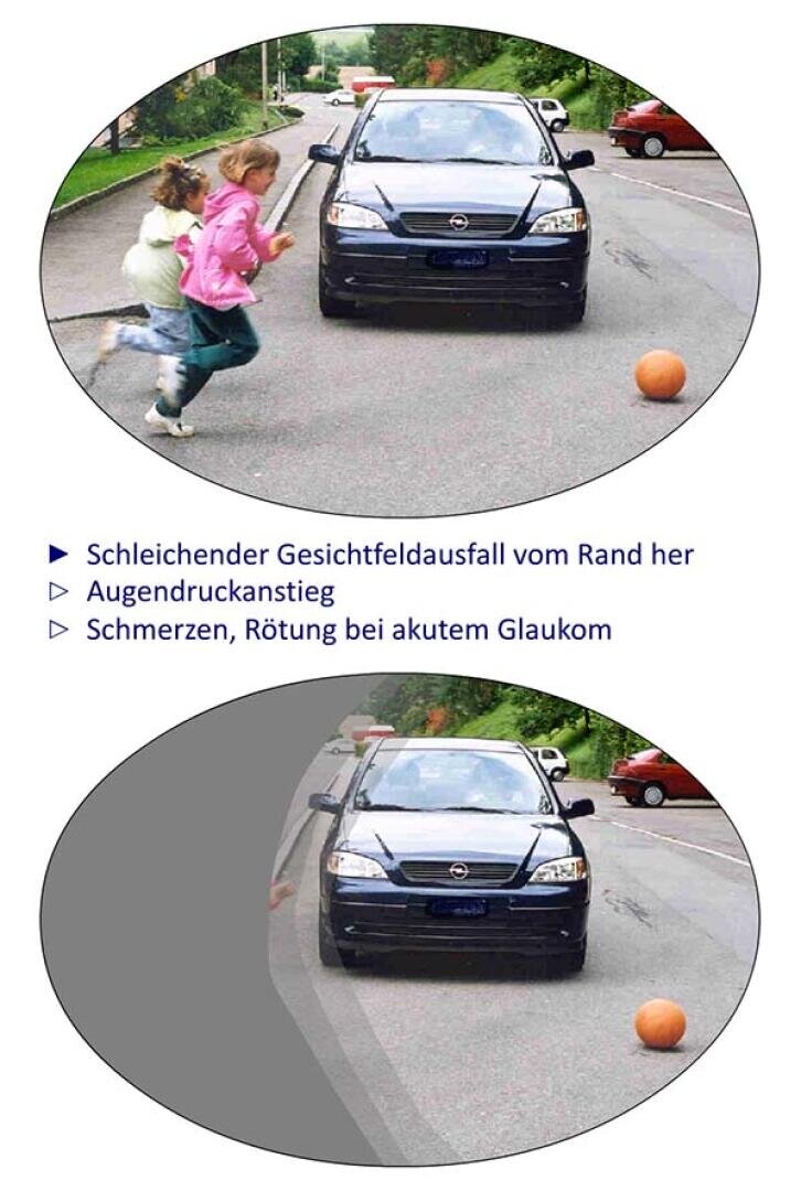 Zwei Kinder jagen einem Ball hinterher und rennen vor einem Auto auf die Straße. Der untere Teil des Bildes zeigt eine ausgegraute Seitenansicht, die einen Tunnelblick simuliert, mit einem deutschen Text, der die Symptome eines Glaukoms beschreibt.