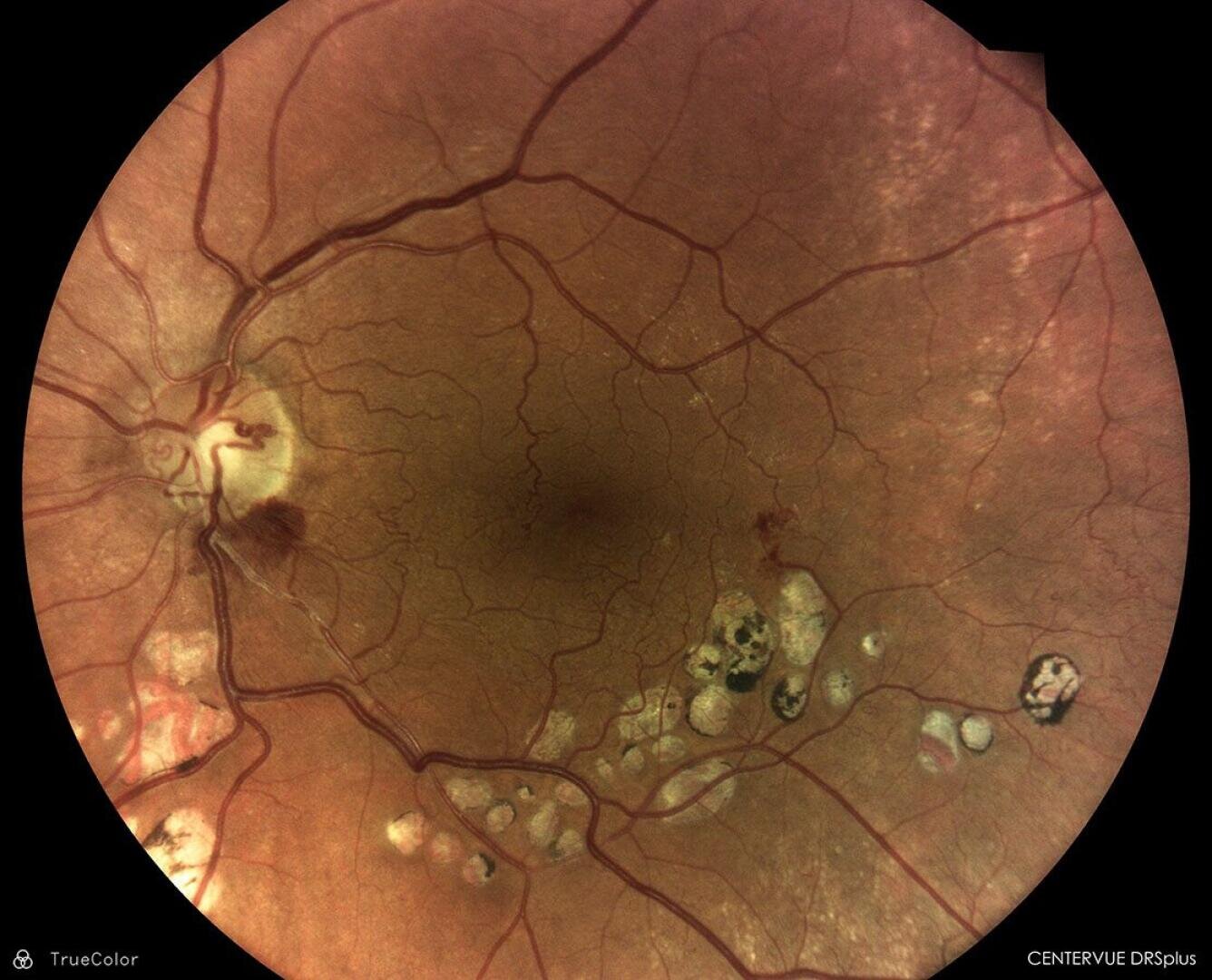 Fundusfotografie eines Auges, die die Netzhaut mit sichtbaren Blutgefäßen, blassen Flecken, Blutungen und abnormalen Stellen zeigt, die auf eine Netzhauterkrankung oder diabetische Retinopathie hindeuten.