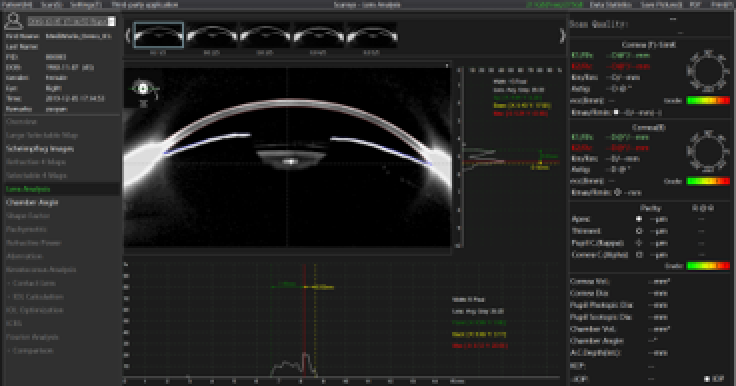 A screenshot of ophthalmic imaging software shows a cross-sectional scan of a human eye with curvature and thickness measurements, with different analysis graphs and data on the right and left sides.