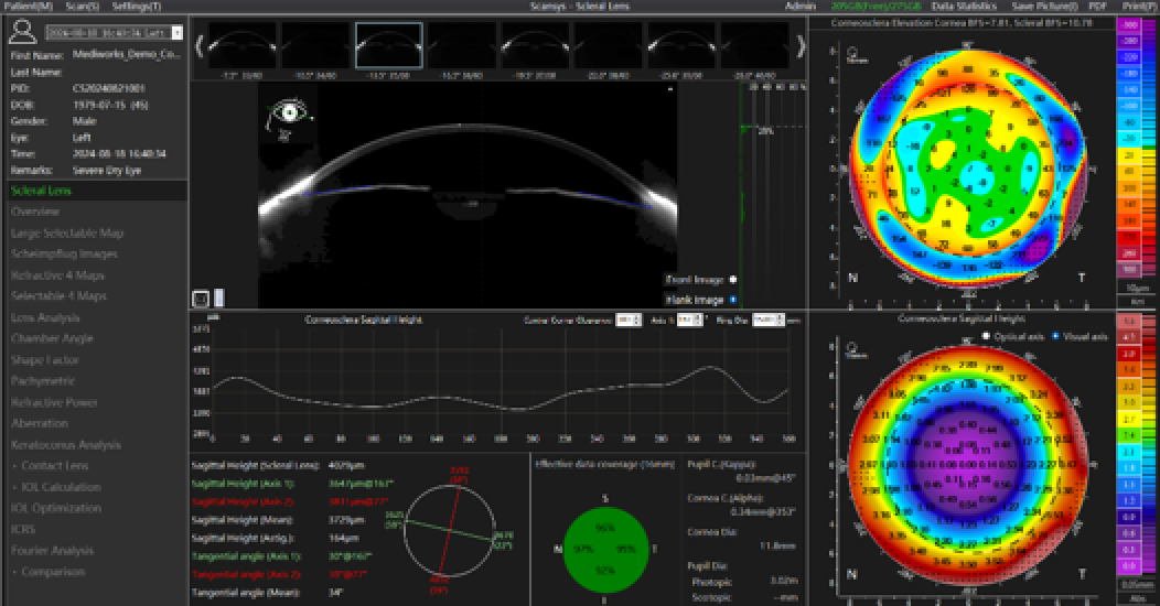 Medical imaging software displays corneal topography data, including a lateral cross-section of an eye, 2D color maps of corneal shape, numerical measurements and charts to analyze corneal surface area and thickness.